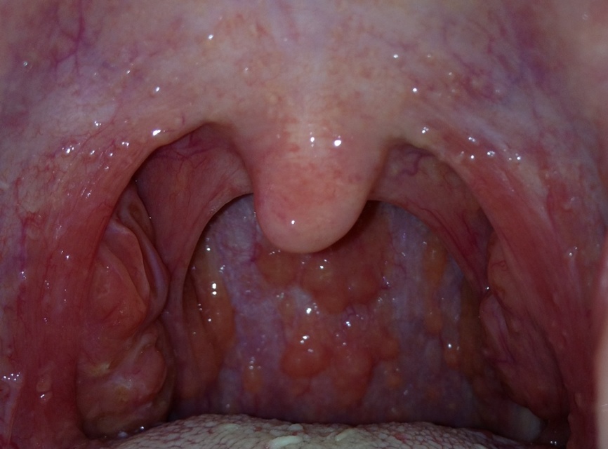 咽喉感覺(jué)有異物感但吞咽正常，原因、影響與處理方法，咽喉異物感解析，成因、影響及應(yīng)對(duì)之策