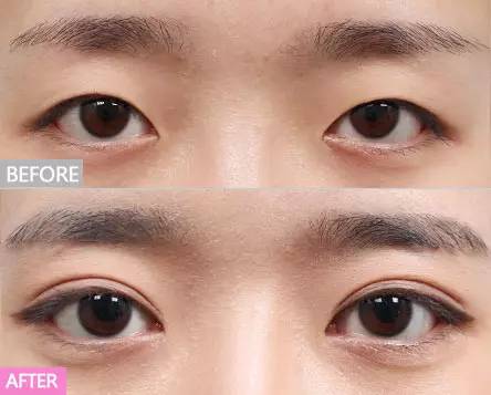 上海割雙眼皮最好的專家，專業(yè)團(tuán)隊(duì)與個(gè)性化設(shè)計(jì)的完美結(jié)合，上海雙眼皮手術(shù)專家團(tuán)隊(duì)，專業(yè)與個(gè)性化設(shè)計(jì)的完美融合