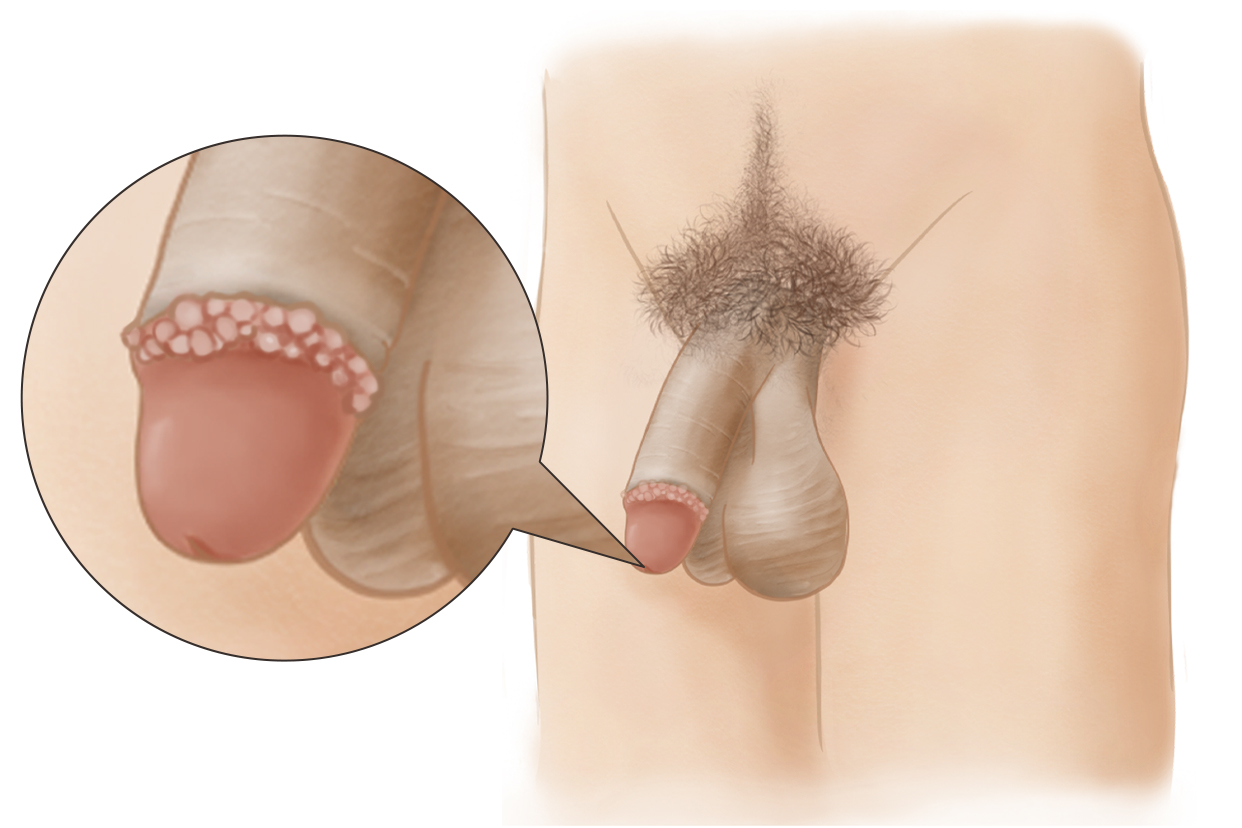 五分鐘教你識(shí)別珍珠疹，五分鐘學(xué)會(huì)識(shí)別珍珠疹的方法