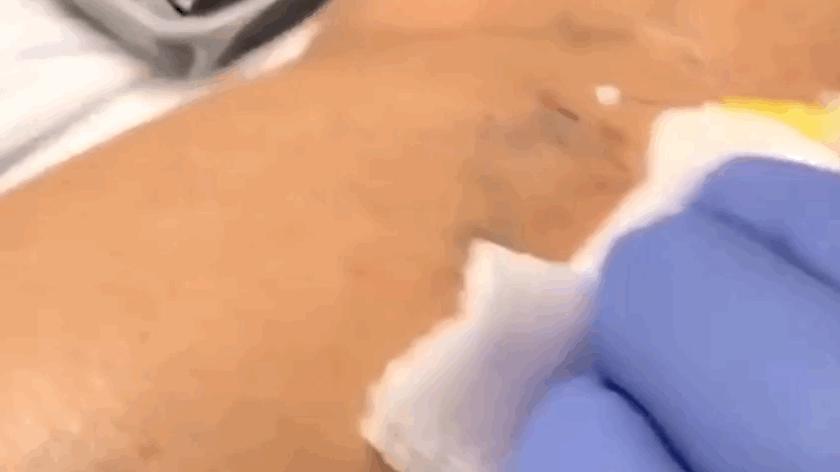 臉色紅血絲的根治方法，了解、預(yù)防與治療，臉色紅血絲的全方位解析，根治方法、預(yù)防與治療策略