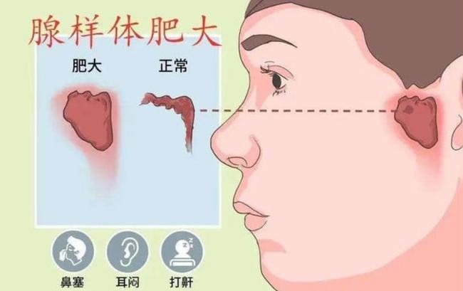 腺樣體肥大能自愈嗎？——深度解析與理解，腺樣體肥大能否自愈？全面深度解析