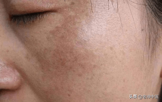 黃褐斑最怕一味中藥，深入解析與應(yīng)對策略，黃褐斑的克星，中藥深度解析與防治策略