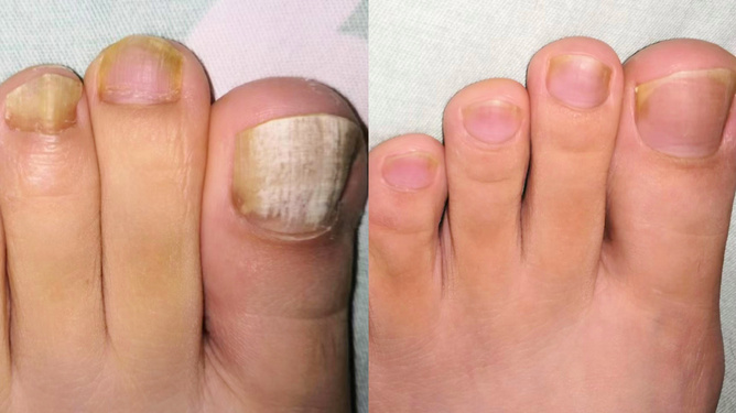 三天見效的灰指甲偏方，讓你輕松告別灰指困擾，三天見效的灰指甲偏方，告別灰指煩惱