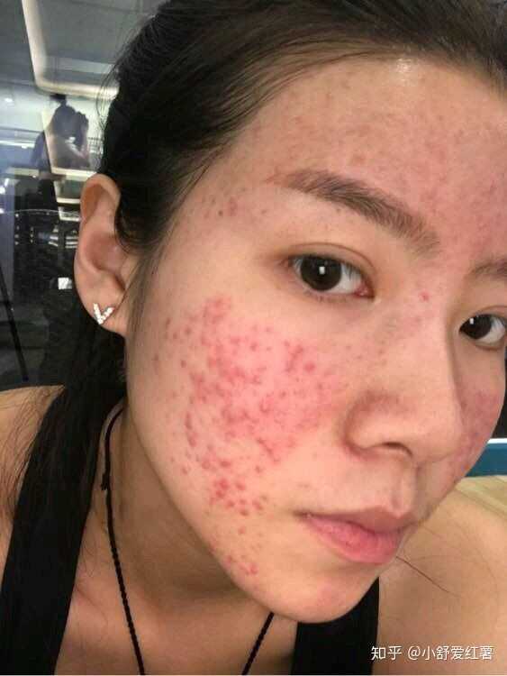 如何有效去除臉上的痘印——全方位指南，全方位指南，如何有效去除臉上痘印的方法
