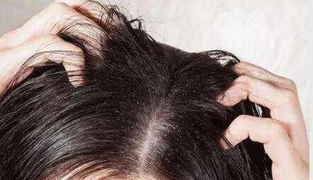 頭皮屑多怎么辦小妙招，全方位解決頭皮問題，全方位解決頭皮問題，頭皮屑多的小妙招匯總