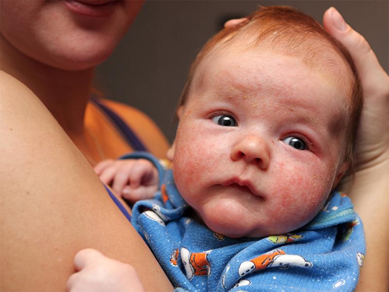 兒童常見的幾種疹子及其識別與處理方法，兒童常見疹子類型、識別與處理方法指南