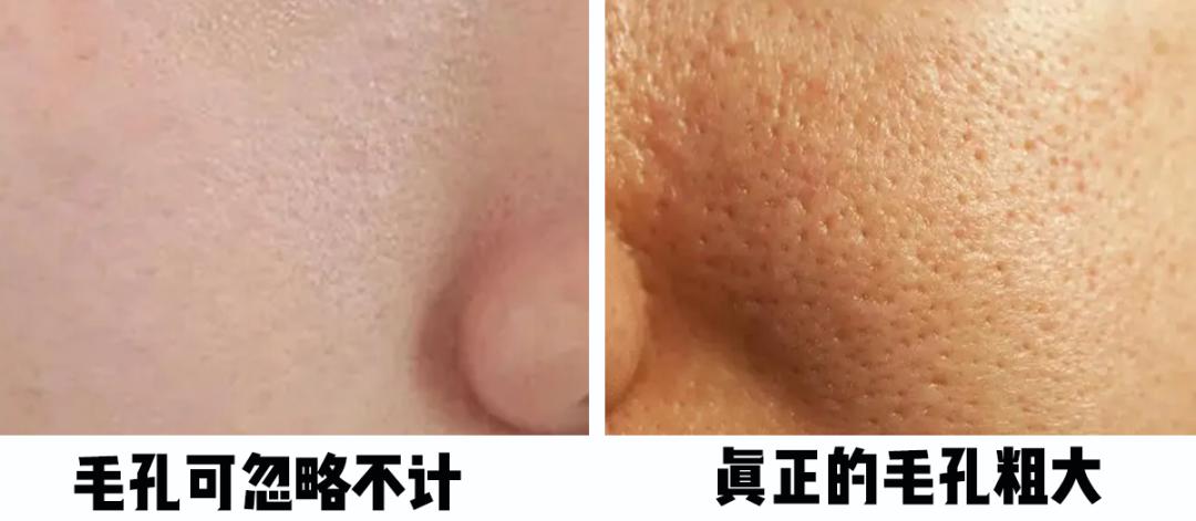 怎樣毛孔可以慢慢縮小，護膚秘籍與實用建議，護膚秘籍，縮小毛孔實用建議與指南