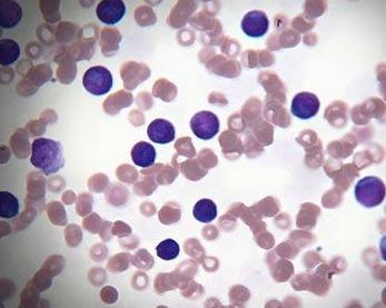 霉菌性陰炎排出物圖片，了解、識(shí)別與治療，霉菌性陰炎排出物詳解，識(shí)別、了解與治療圖片指南