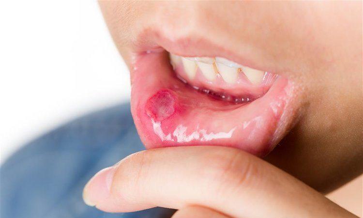 頜下淋巴結(jié)腫大圖片及其相關(guān)解析，頜下淋巴結(jié)腫大詳解，圖片與解析指南