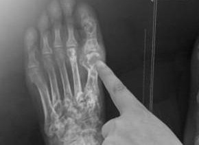 治療痛風(fēng)的最佳方法，治療痛風(fēng)的最佳方法簡(jiǎn)介