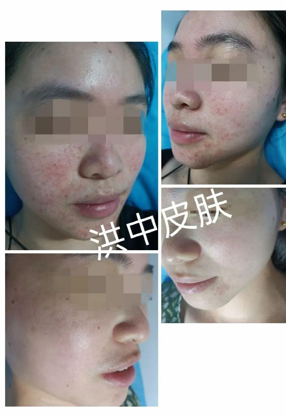 痤瘡圖片的樣子，深入了解痤瘡癥狀與表現(xiàn)，痤瘡癥狀深度解析，圖片展示痤瘡表現(xiàn)與形態(tài)