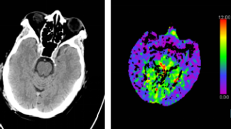 腦CT沒事就代表大腦沒事嗎？深入探討腦部健康與CT檢查的關(guān)系，腦部健康與CT檢查，CT無異常是否代表大腦無隱患？