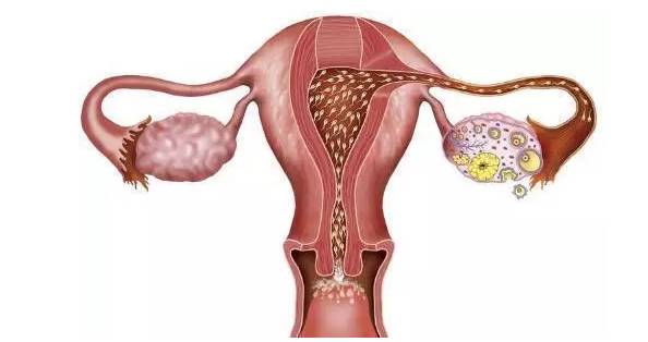 小姑娘為什么會得卵巢囊腫，小姑娘患卵巢囊腫的原因分析