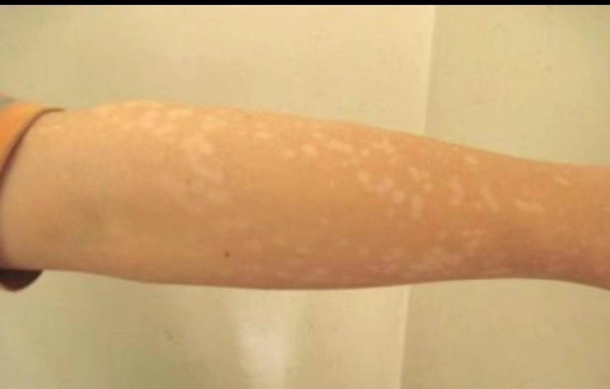 白斑與汗斑的區(qū)別圖，深入了解兩種皮膚狀況的差異，白斑與汗斑的區(qū)別詳解，圖解兩者皮膚狀況差異