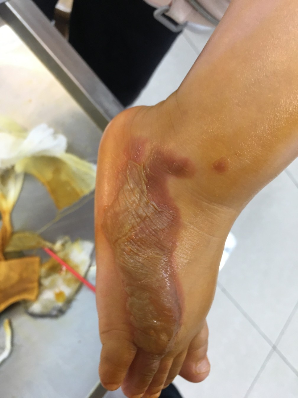 燙傷后如何選用最佳藥膏，避免留下疤痕，燙傷藥膏選擇與疤痕預(yù)防，燙傷后的最佳護(hù)理指南