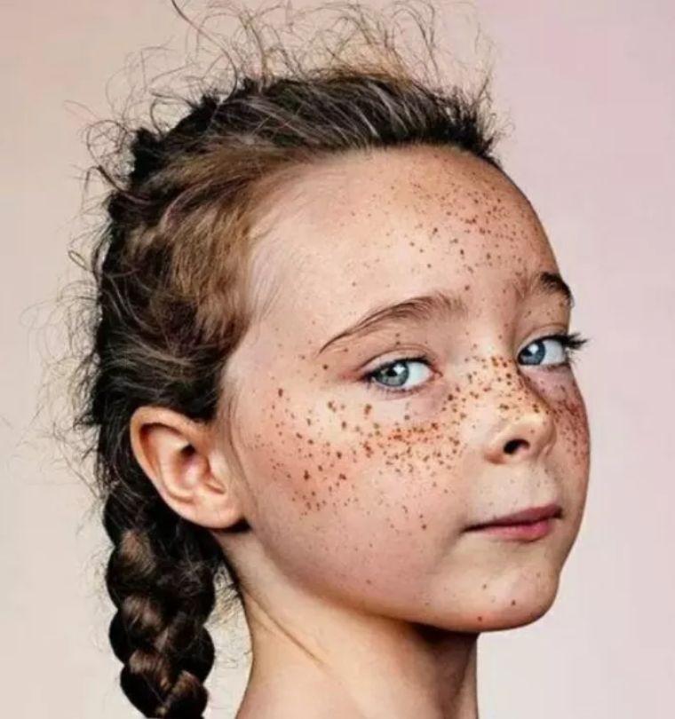 重度痤瘡小偏方，自然療法助你擺脫皮膚困擾，自然療法小偏方助擺脫重度痤瘡皮膚困擾