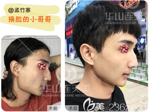 削顴骨手術費用詳解，手術費用大概要多少錢？，削顴骨手術費用詳解，手術費用及預算指南