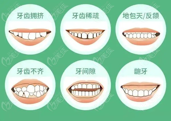 牙齒正畸費(fèi)用詳解，一般多少？，牙齒正畸費(fèi)用全面解析，了解一般價(jià)格及影響因素