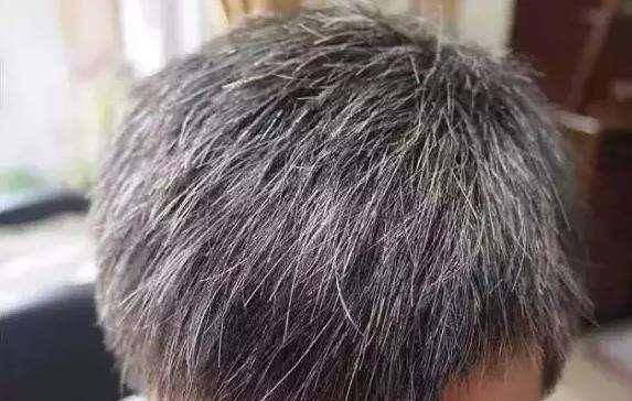 治療白發(fā)最好的方法，逆轉(zhuǎn)歲月痕跡，重拾烏黑亮澤秀發(fā)，逆轉(zhuǎn)白發(fā)秘訣，重拾烏黑亮澤秀發(fā)的最佳治療方法！