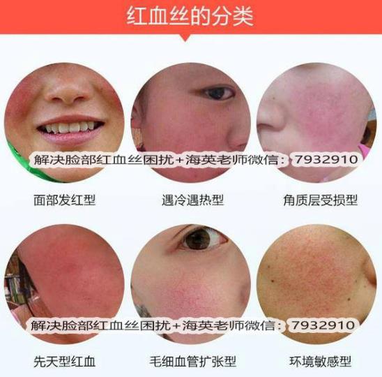 臉上出現(xiàn)紅血絲怎么治療，全面解析有效方法，臉上紅血絲全面解析與有效治療方法