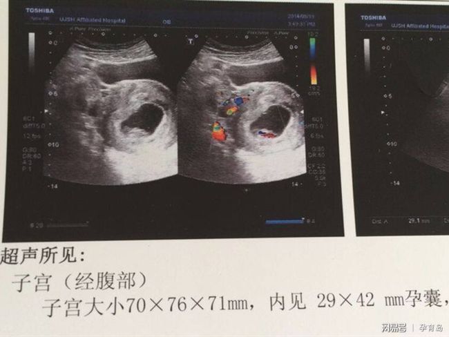 有卵黃囊基本就穩(wěn)了，早期妊娠的穩(wěn)固跡象與注意事項，早期妊娠的穩(wěn)固跡象，卵黃囊出現(xiàn)后的穩(wěn)定與注意事項
