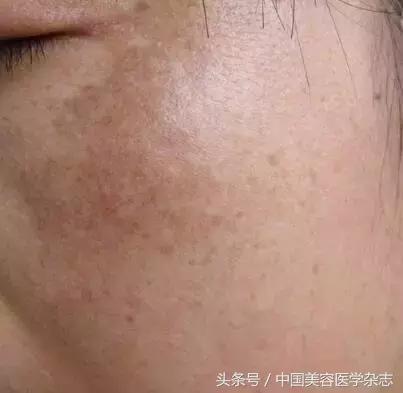 黃褐斑怎么治療最有效，全面解析最佳療法，全面解析黃褐斑最佳治療方法，最有效的療法選擇