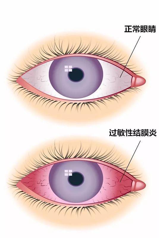 過(guò)敏性結(jié)膜炎，癥狀、原因及防治策略，過(guò)敏性結(jié)膜炎詳解，癥狀、成因與防治策略