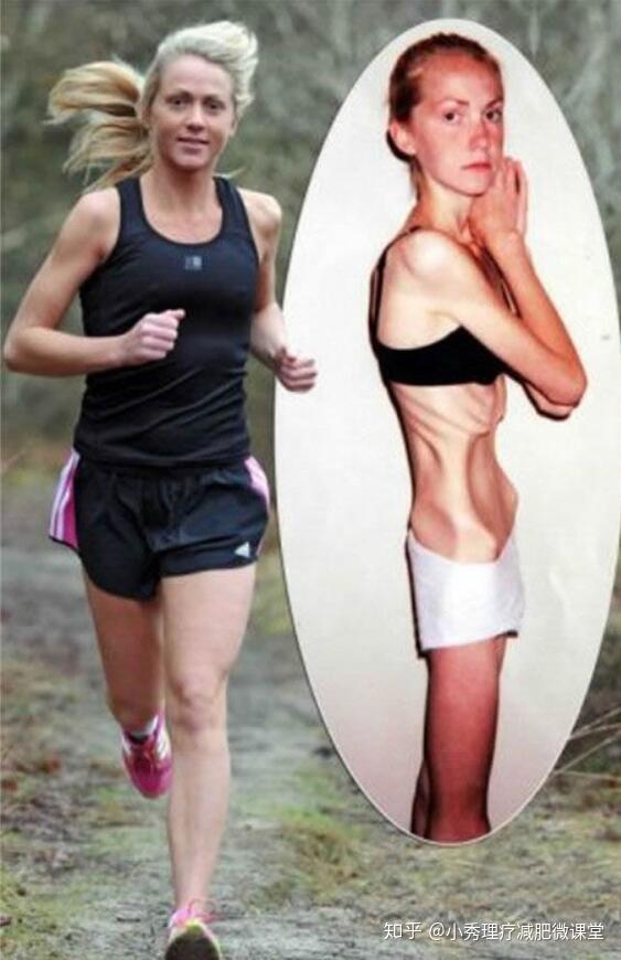 厭食癥的10個(gè)前兆