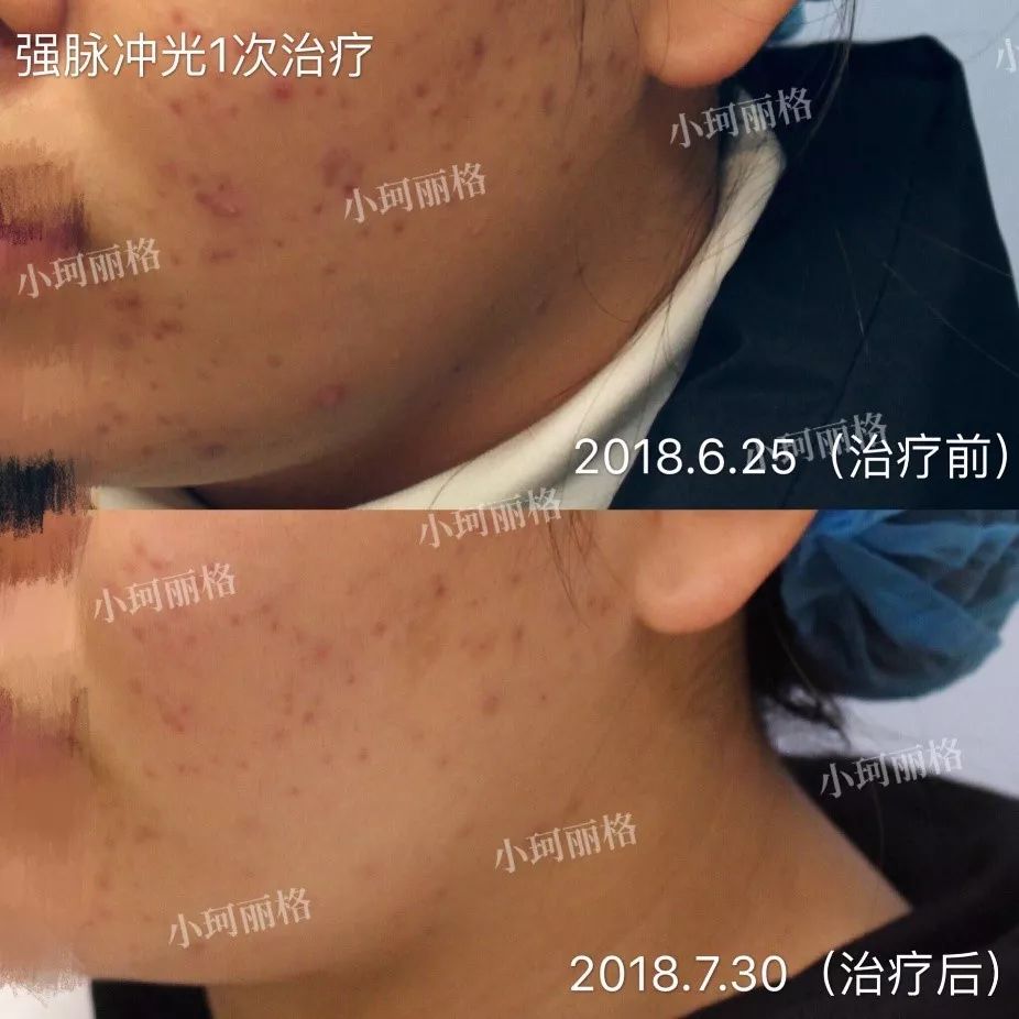 粉刺痤瘡怎樣徹底治愈，全面解析與有效方法，粉刺痤瘡全面解析，如何徹底治愈與有效防治方法