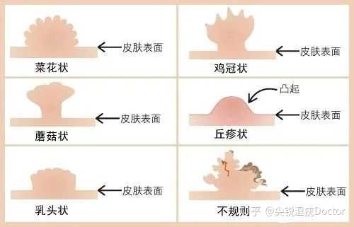 女性如何自己判斷真假尖銳濕疣？，女性如何自主辨別真假尖銳濕疣？