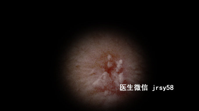 尖銳濕疹，深入了解與治療建議，尖銳濕疹，深度解析與治療指南