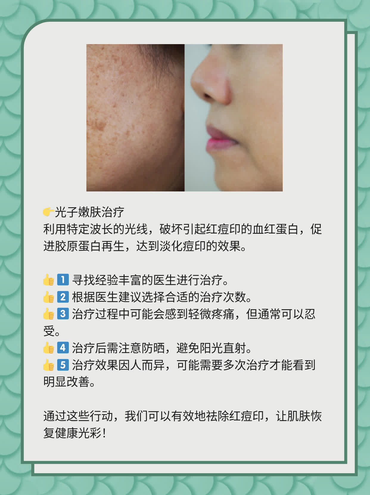 如何有效去除紅痘印，一站式解決方案，一站式解決紅痘印問題，有效去除方法大全