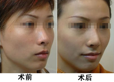 光子嫩膚做一次有效嗎？深入了解光子嫩膚的效果與過(guò)程，光子嫩膚效果與過(guò)程解析，做一次是否有效？
