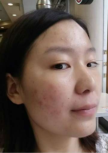 如何有效去除臉上痘痘——多種方法助您重拾肌膚光彩，多種方法助您有效去除臉部痘痘，重拾肌膚光彩