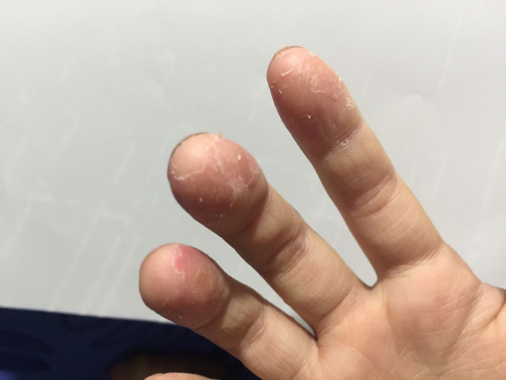 手指脫皮是什么原因，深度解析與應對建議，手指脫皮深度解析，成因、應對與建議