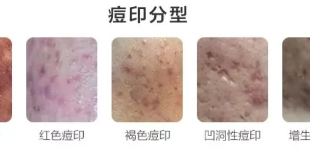 怎樣去痘印效果最好的方法，揭秘最佳去痘印方法，告別臉部瑕疵！