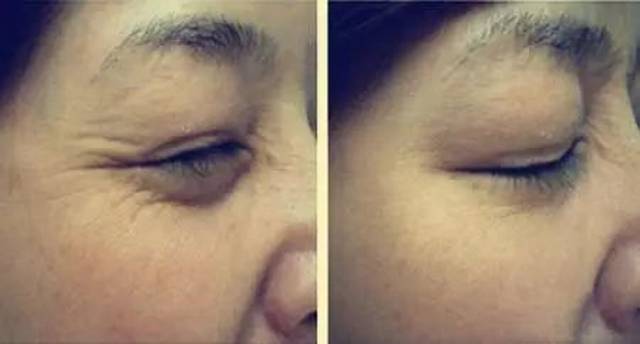 肉毒素除皺的副作用深度解析，肉毒素除皺副作用深度解析