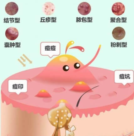 痤瘡忌口食物清單，戰(zhàn)勝痘痘，從飲食開始，戰(zhàn)勝痘痘，痤瘡忌口食物清單助你調(diào)整飲食，遠離皮膚困擾