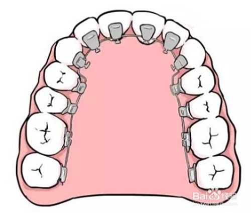 牙套價(jià)格詳解，裝一個(gè)牙套需要多少錢(qián)？，牙套價(jià)格全解析，裝牙套需要多少錢(qián)？