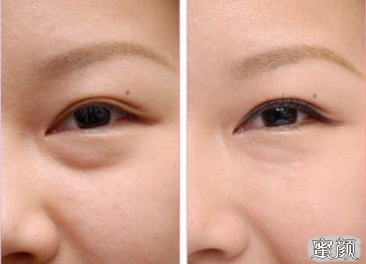 如何消除眼袋，簡(jiǎn)單實(shí)用的方法，消除眼袋的實(shí)用方法與技巧