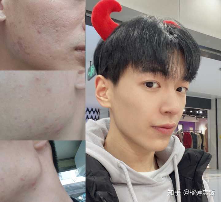 如何有效去除臉上的痘印——全方位指南，全方位指南，如何有效去除臉上痘印的方法