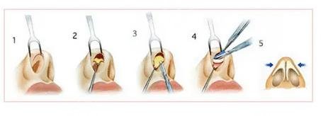 微調(diào)鼻子需要多少錢，全面解析費(fèi)用因素與注意事項(xiàng)，微調(diào)鼻子費(fèi)用全解析，費(fèi)用因素與注意事項(xiàng)，需要多少錢？