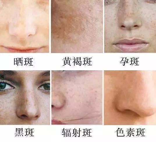 如何有效去除臉上斑點(diǎn)——全方位指南，全方位指南，如何有效去除臉上斑點(diǎn)