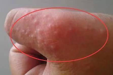 生殖上長小水泡的原因，深度解析與應(yīng)對建議，生殖部位小水泡成因深度解析及應(yīng)對建議