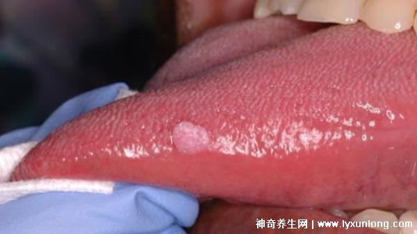 關(guān)于HPV感染舌頭初期的圖片及其相關(guān)解析，HPV感染舌頭初期癥狀圖片與解析