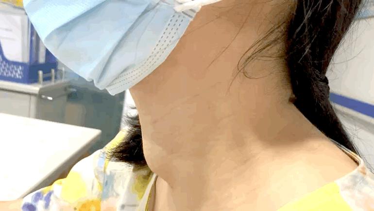 甲狀腺結(jié)節(jié)是被氣的嗎？深入了解甲狀腺結(jié)節(jié)的成因與防治，甲狀腺結(jié)節(jié)成因與防治，情緒因素與疾病關(guān)系探討