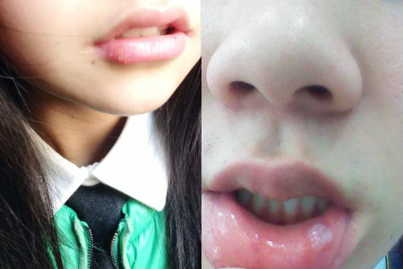 唇上長(zhǎng)水泡如何快速消除，原因、治療與預(yù)防，唇上長(zhǎng)水泡，快速消除、原因分析及治療與預(yù)防方法