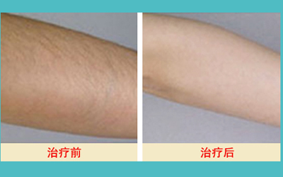 激光脫毛的價格解析，多少錢才能擁有絲滑肌膚？，激光脫毛價格詳解，多少錢能擁有絲滑肌膚？